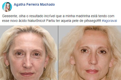 Dermalifting